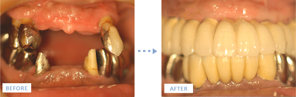 骨の造成後の上顎オールオン4、下顎前歯7本分のインプラント治療前後の写真