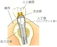 歯茎に埋め込められたインプラントの構造説明図