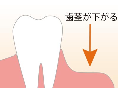 歯茎が下がる