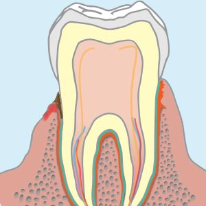 歯周病の歯