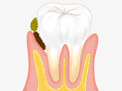 プラークのこびりついた歯