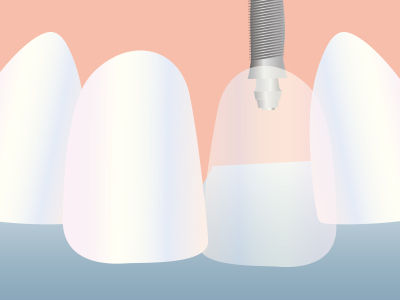 前歯のインプラント