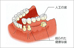 1、2本の歯を失った場合の従来の治療法（ブリッジ）