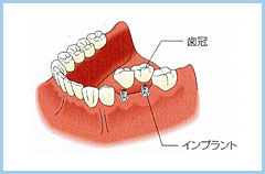 1、2本の歯を失った場合のインプラント治療方法