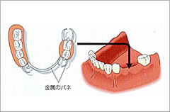 奥歯複数法を補うための金属のバネを使った入れ歯