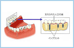 奥歯複数本を少ないインプラント補えるインプラント治療