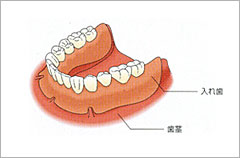 1、2本の歯を失った場合の従来の治療法（ブリッジ）