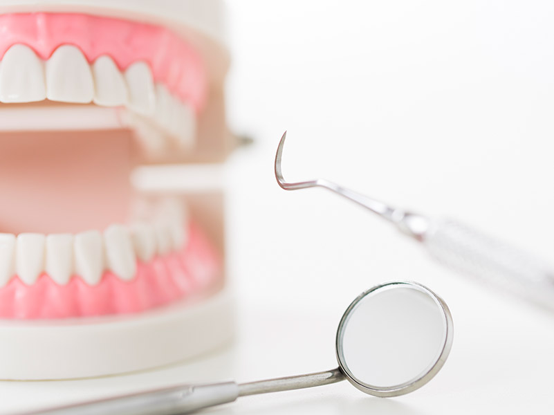 奥歯のインプラント治療の注意点