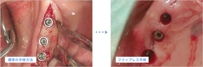 通常のインプラント手術法とフラップレス手術法の違い