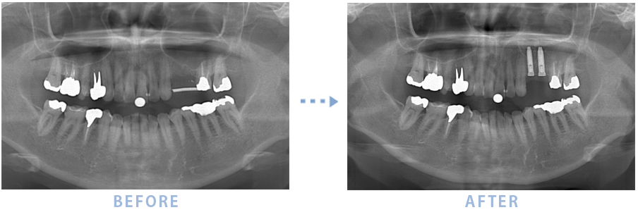 2014年7月のインプラントの症例1