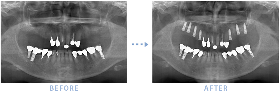 いしかわインプラント かとうクリニックの最近のインプラントの治療症例 いしかわインプラント かとうクリニック